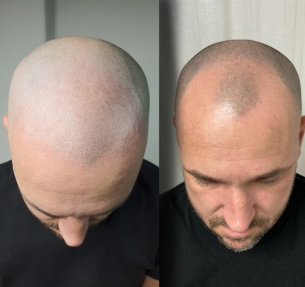 mikropigmentacija-skalpa